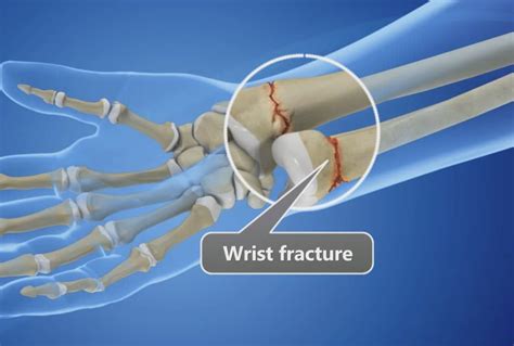 Surgery for a wrist fracture is not always necessary - Southern Hand ...