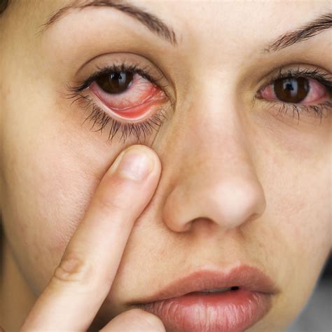 Mandeville, LA Conjunctivitis FAQ: Pink Eye Causes, Symptoms, Treatments