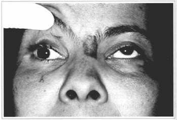 RBCP - Superior Orbitary Fissure Syndrome by Face Trauma Without Medial Third Fracture - Case Report