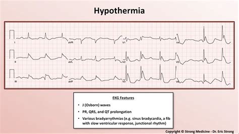 Hypothermia Ecg