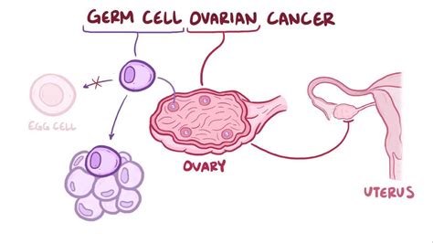 Video: Germ cell ovarian tumor