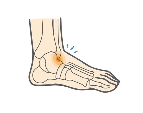 What is an Anterior Ankle Impingement & How is It Managed? - Upswing Health