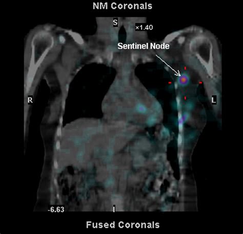 Sentinel Lymph Node Biopsy Information - Dr Ben Lancashire