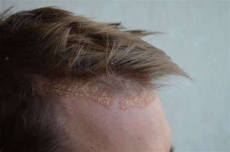 Plaque Psoriasis Hair Loss at Andrew Knight blog