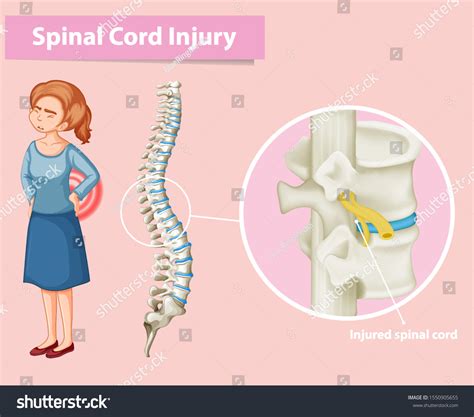 Diagram Showing Spinal Cord Injury Human Stock Vector (Royalty Free) 1550905655 | Shutterstock