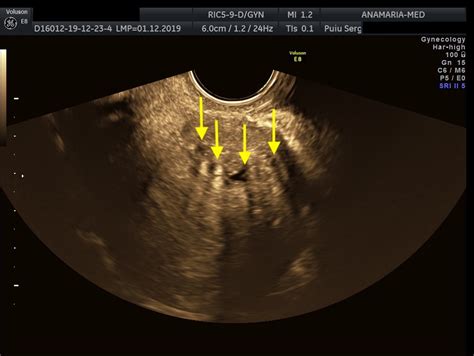 Ultrasound diagnosis of bladder endometriosis [Dec 2022] – EFSUMB