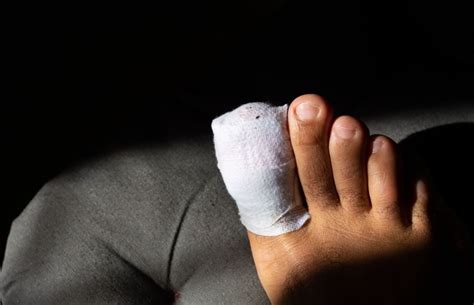 Surgery Options for a Recurring Digital Mucous Cyst on Toe