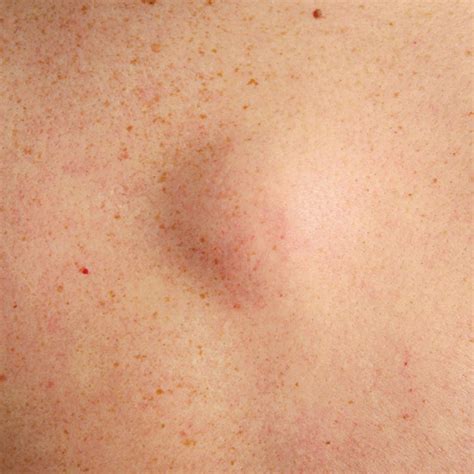 A Photo Guide To All the Random-Ass Bumps On Your Body - Hot World Report