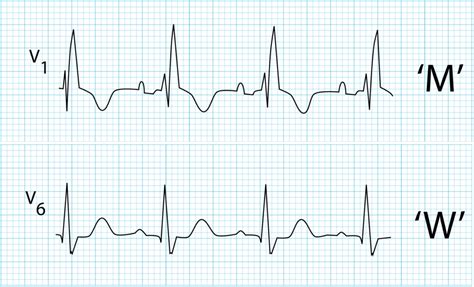 Right Bundle Branch Block (RBBB) • LITFL • ECG Library Diagnosis