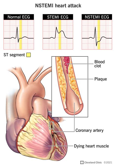 NSTEMI: Causes, Symptoms, Diagnosis, Treatment & Outlook