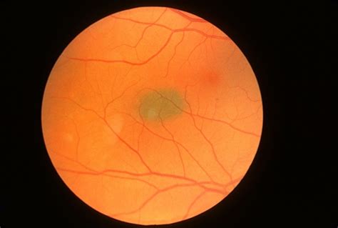 Choroidal Nevus - Retina Image Bank