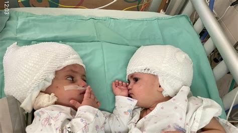 Conjoined twins joined at the head are separated after 12-hour surgery in Israel - ABC11 Raleigh ...