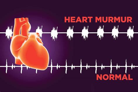 Still's murmur definition, Still's murmur description & diagnosis