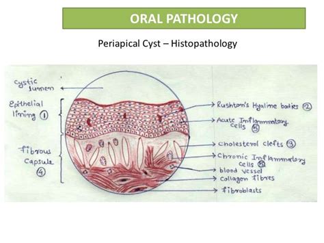 Radicular cyst or Periapical cyst