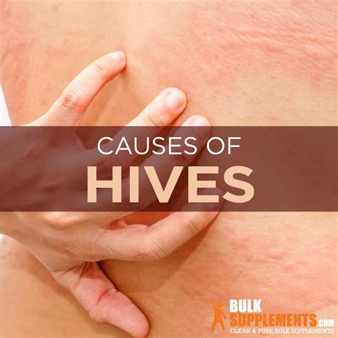 Hives: Symptoms, Causes & Treatment