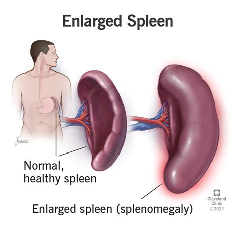 Enlarged Spleen (Splenomegaly): Symptoms, Causes Treatment, 57% OFF