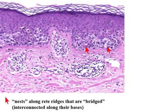 The Clark Melanocytic Nevus (Dysplastic Melanocytic Nevus, Atypical ...