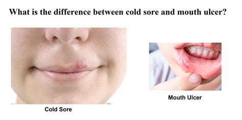 Canker Sore Vs Cold Sore Inside Lip