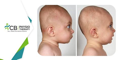 Infant Head Shape | How physiotherapy can help attain a round head ...