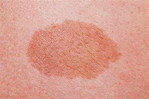 Ipilimumab Indication Expanded To Include Pediatric Unresectable or Metastatic Melanoma - Cancer ...