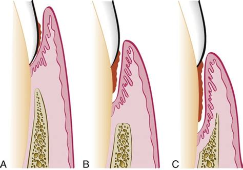 20: The Periodontal Pocket | Pocket Dentistry