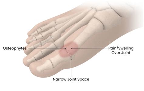 Great Toe Mtp Joint