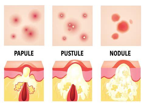 Cystic Acne — The Acne Lab