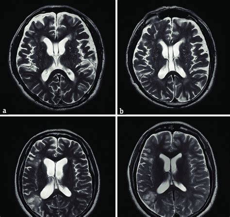 The brain magnetic resonance imaging before the shunt surgery revealed ...