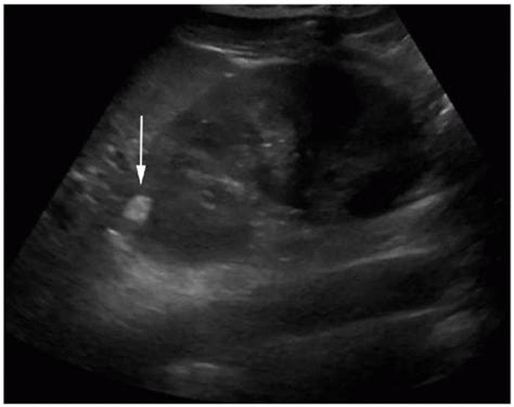 Kidney Tumor Ultrasound