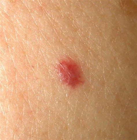 Cherry Angiomas - Pictures, Symptoms, Causes, Treatment, Removal - HubPages