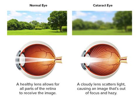 Cataract Treatment Surgery IOL | Massillon and North Canton, Ohio