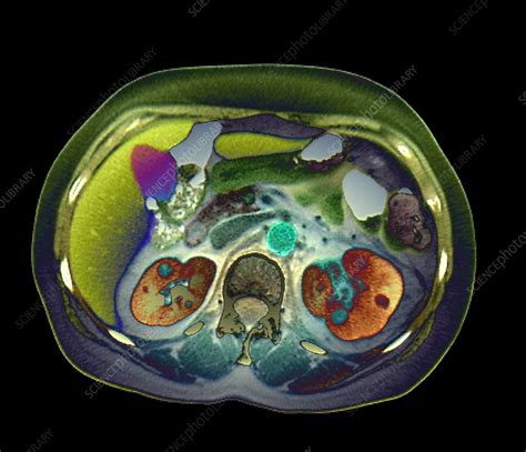 Pyelonephritis, axial CT scan - Stock Image - C047/4749 - Science Photo ...