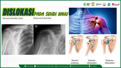 DISLOKASI PADA SENDI BAHU - Rumah Sakit Ortopedi Soeharso Surakarta