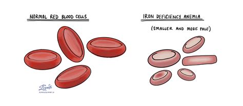 Iron deficiency anemia - MyPathologyReport.ca