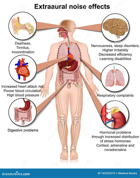 Extraaural Health Effects of Chronic Noise Exposure Medical Illustration Stock Vector ...