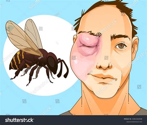 Bee sting. Swollen face. Swollen eye. Injury - Royalty Free Stock Vector 2341342039 - Avopix.com