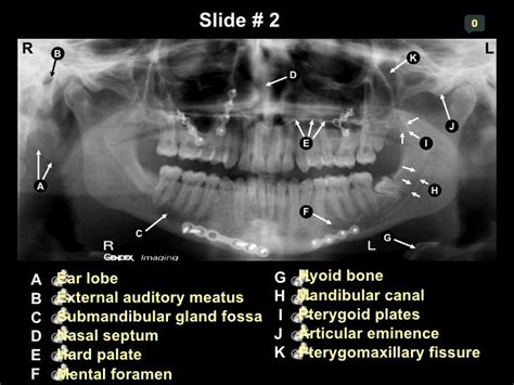 OPG labelled - Google Search | Dental hygiene student, Dental hygiene ...