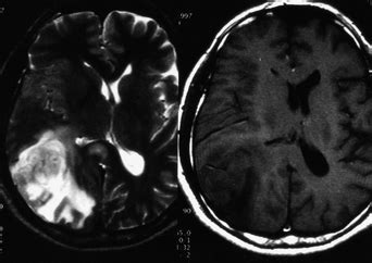 case 1: 45 year-old man with a sustained right parietal headache for 2 ...