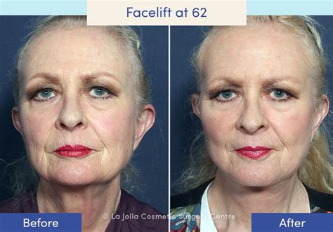 Facelift Before & After Photos: What a Facelift Looks Like at 40, 50, 60 & 70 | Facelift in San ...