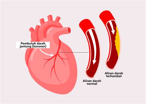 Penyakit Jantung Koroner – newstempo
