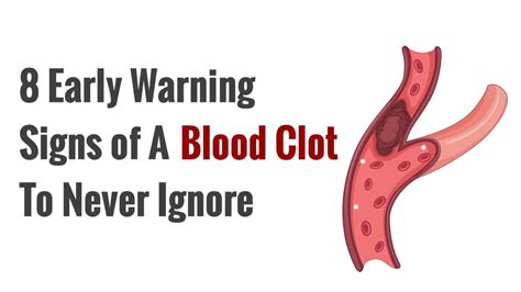 Blood Clot Symptoms / 5 Simple And Effective Preventions For Blood Clots ... : This can result ...