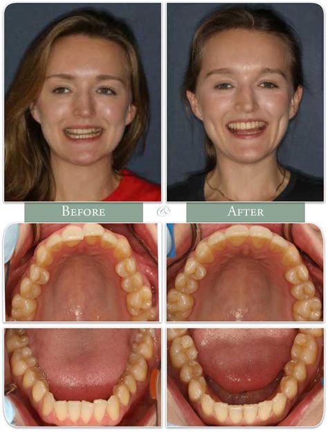 Invisalign Jaw Alignment Before And After | Before And After