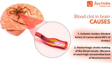 Blood Clot In Brain- Causes, Symptoms, Treatment, And Lot More