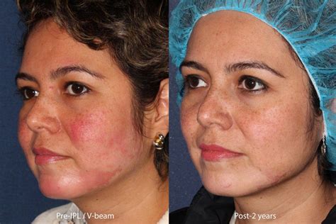 Rosacea Facial Redness Treatment by San Diego Specialists