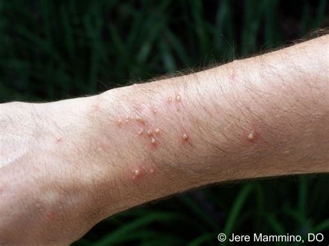 Fire Ant Bites - American Osteopathic College of Dermatology (AOCD)