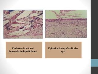 Periapical cyst | PPT