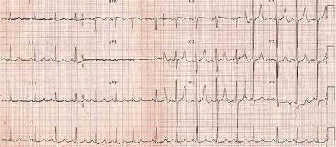 Tall peaked T waves – All About Cardiovascular System and Disorders