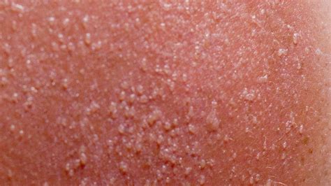 Sun Poisoning: Causes, Symptoms, Prevention and Treatment | Healthtian