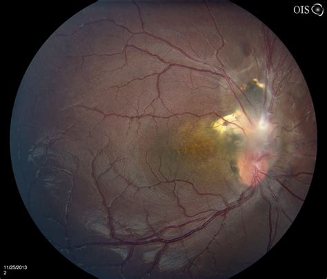 Optic Nerve Tumor - Retina Image Bank