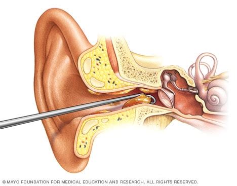 Ear Wax Removal Kit Catalina - Oro Valley Audiology